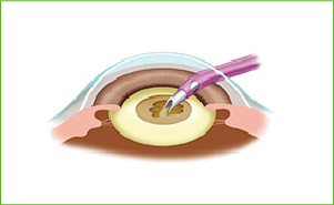 にごった水晶体を砕いて吸い出します