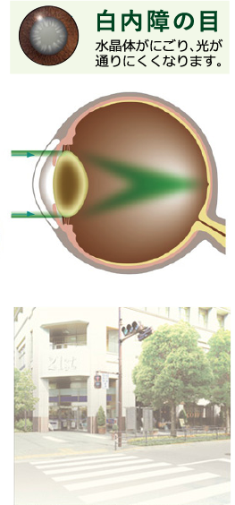 白内障の目